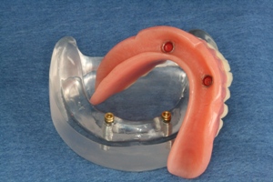 An image of snap-on dentures as a means of affordable dental implants