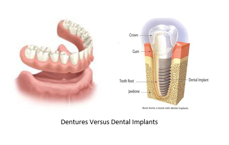 A side by side image of bottom dentures next to an illustration of a dental implant