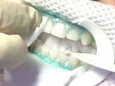 A person getting protection placed on their gums for teeth whitening