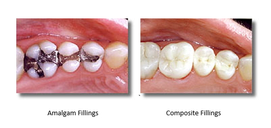Two images. One with silver amalgam fillings. One with mercury-free white composite fillings