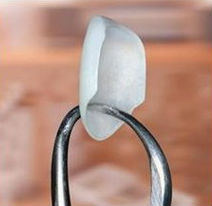 Lumineers wafer being held up by a dental tool
