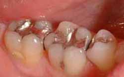 Before mercury-free dentistry photo of molar teeth with amalgam fillings.