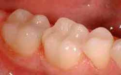 After mercury-free dentistry photo of molar teeth that had amalgam fillings replaced with composite.