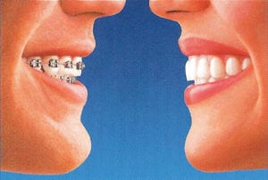 Side by Side comparison fo braces with Invisalign