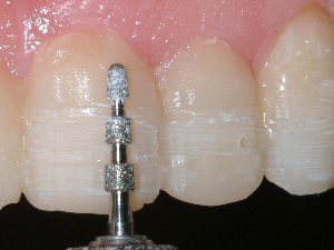 Tooth being prepped for porcelainv