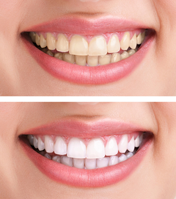 Before and after photo of teeth whitening from Baton Rouge cosmetic dentist Dr. Steven Collins.
