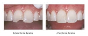 A chipped tooth before and after dental bonding