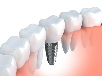 Image of a dental imlant next to natrual teeth