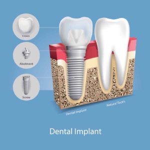 Illustration of a natural tooth next to a dental implant
