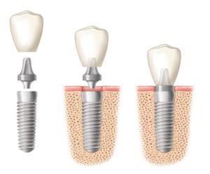 Implant crown being placed on a dental implant