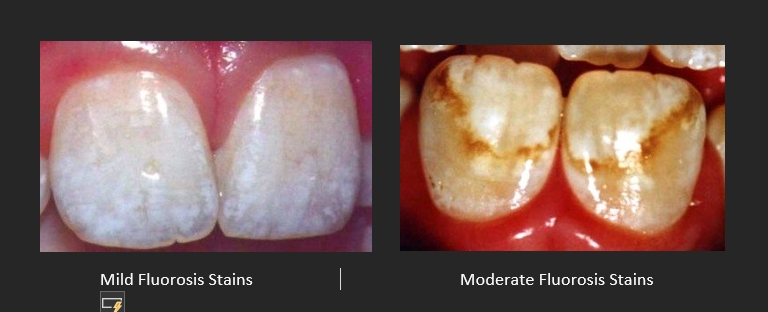mild and moderate fluorosis stains