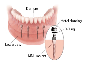 Baton Rouge implant overdenture