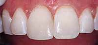 Baton Rouge Teeth Bonding - After