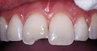 Baton Rouge Teeth Bonding - Before