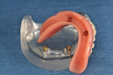 Photo of snap-on dentures, for affordable dental implants from Baton Rouge dentist Dr. Steven Collins.